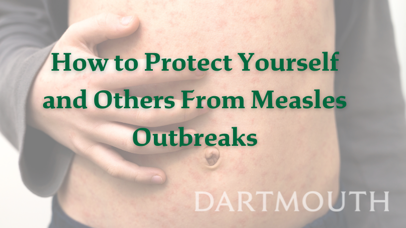 measles 